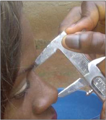 Figure 3: Measurement of nose length of a 24-years-old Ejagham female subject