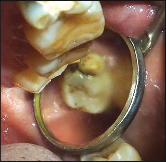 Figure 4: Parastyle on 28; the associated tooth is decayed