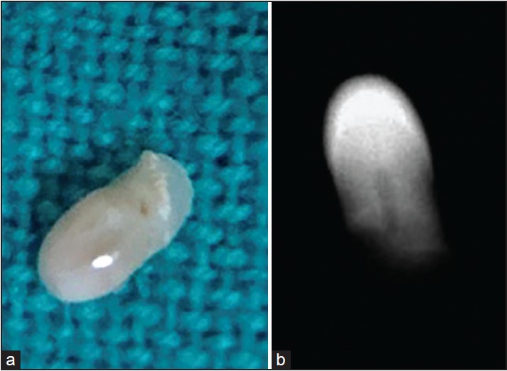 Figure 6: (a) Specimen of protostylid on 48 after extraction of the tooth (b) Radiograph of specimen of protostylid on 48