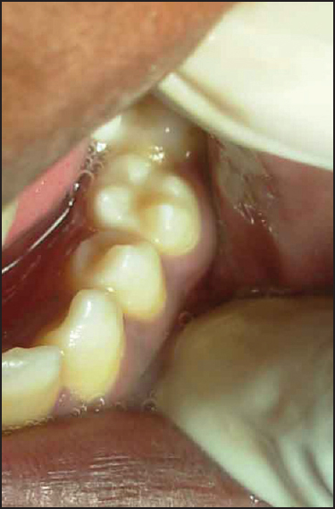 Figure 2: Photograph showing the mandibular second left premolar with four cusps looking like a molar (molarized premolar)