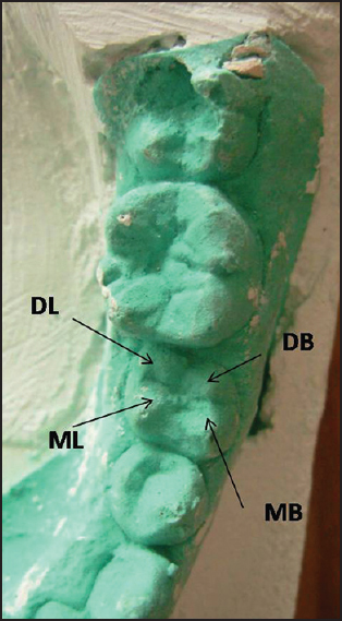 Figure 4: Dental cast showing four cusps in the second premolar (MB = Mesiobuccal, DB = Distobuccal, DL = Distolingual, ML = Mesiolingual)