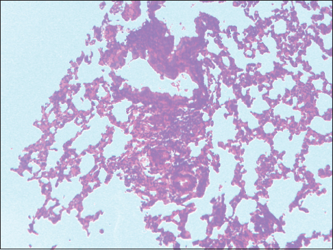 Figure 2: Formalin pigment in a section of the lungs, ×100