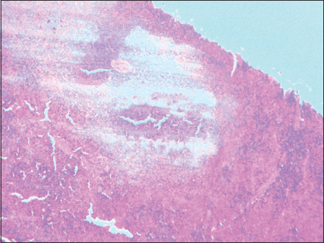 Figure 6: Residual wax in a section of the spleen, ×100