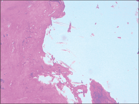 Figure 8: Contaminant artifact in a section of the bone marrow, ×100