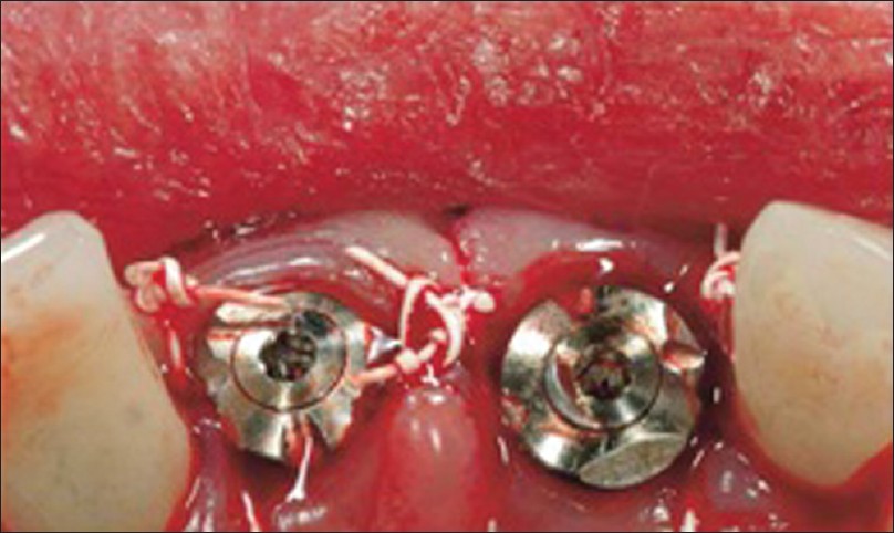 Figure 8: After removing the index, the surgeon places the encoded healing abutments