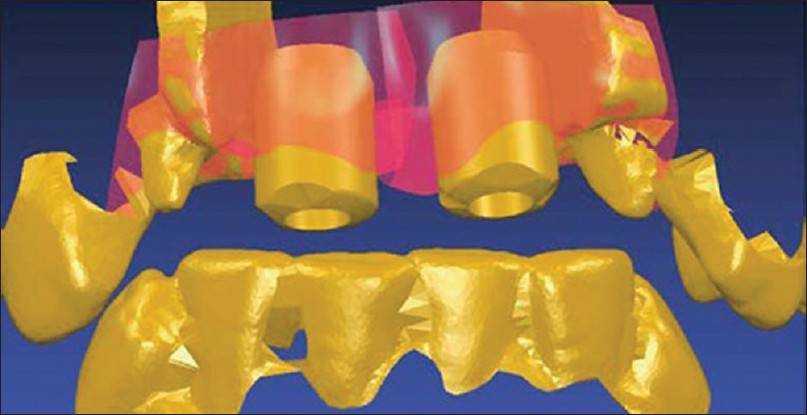 Figure 12: An optical scanner translates the data to a virtual soft image of the encoded abutments, teeth, and the surrounding soft tissues
