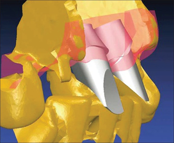 Figure 13: Patient specifi c fi nal abutments are created virtually on a
computer monitor