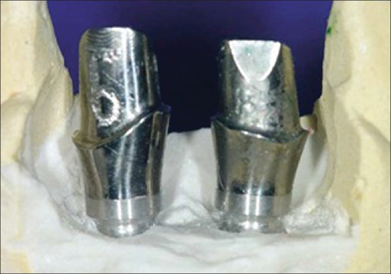 Figure 14: Completed titanium custom abutments are returned to the laboratory, where they are placed on the cast from the surgical implant positioning index