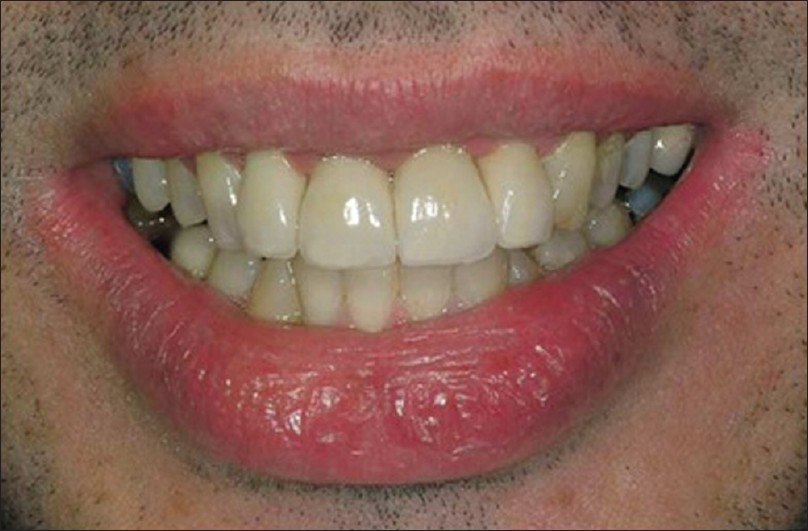 Figure 17: Definitive metal ceramic restorations are cemented in place