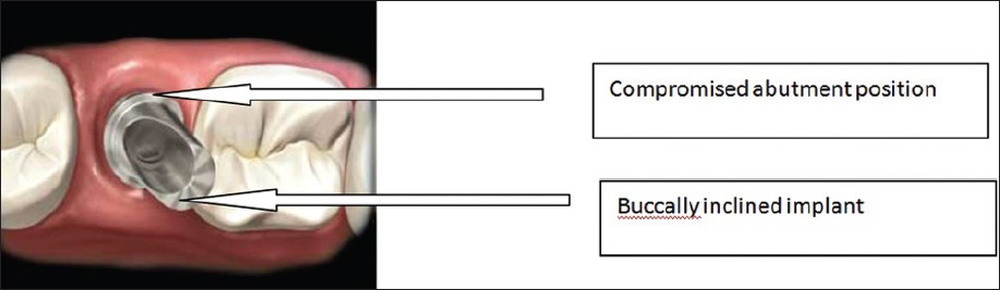 Figure 2: Pre-machined abutments can have positioning limitations because of the number of rotational positions within the internal connection implant design