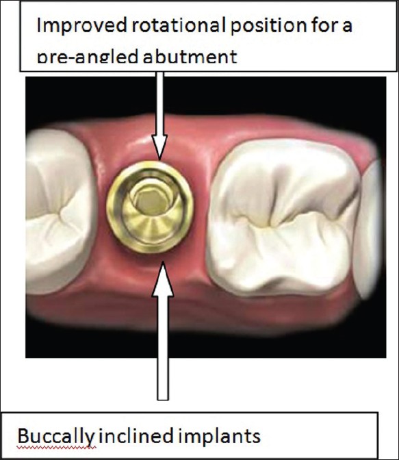 Figure 3: Ideal rotational position for a pre-angled abutment
