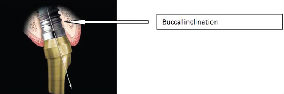 Figure 4: Pre-angled abutment in place redirect the path of insertion for a bucally inclined implant