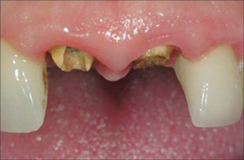Figure 6: Both fractured maxillary central incisors is replaced with implant restorations