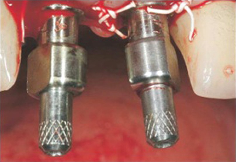 Figure 7: After implant placement, the surgeon seats direct impression copings