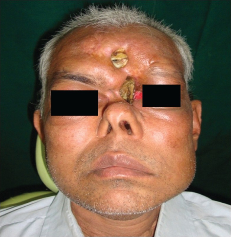 Figure 1: Pre-operative showing defect at nasal bridge and focal area of frontal bone