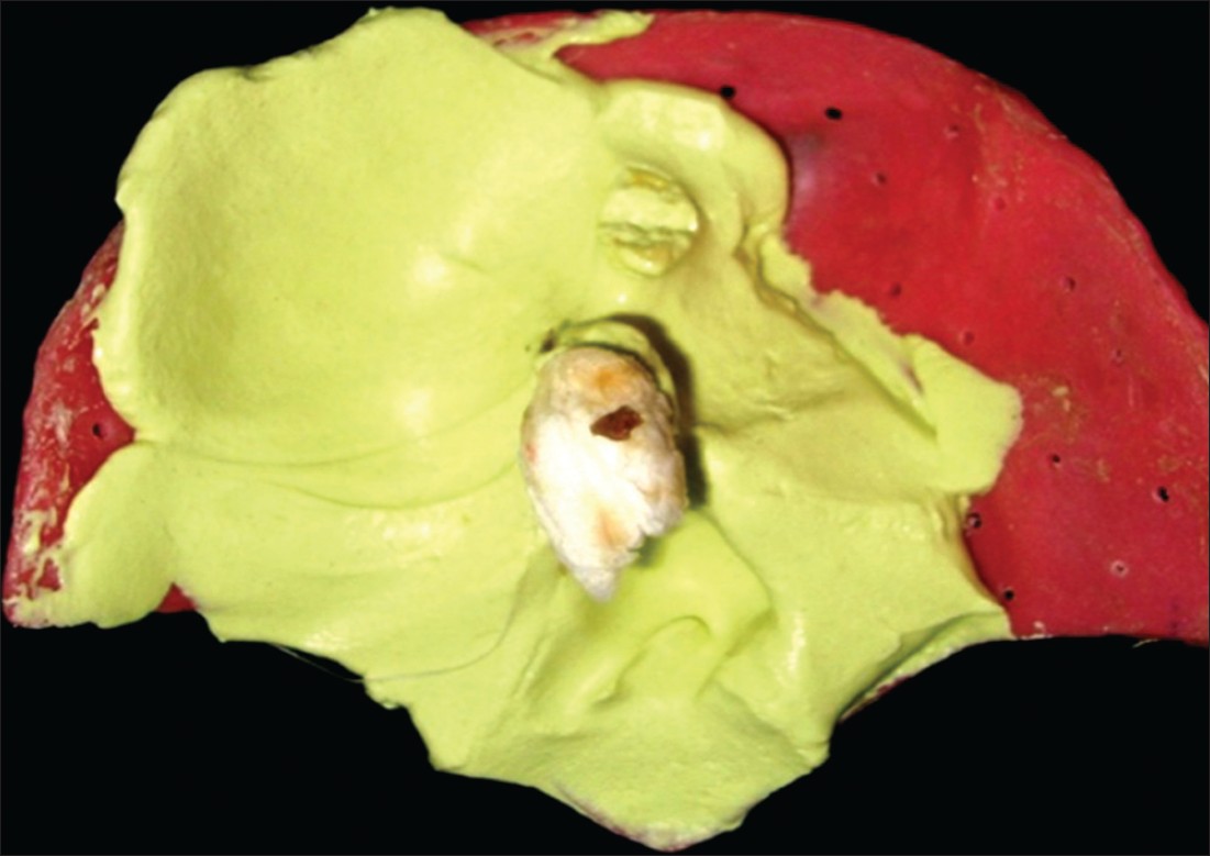 Figure 2: Impression of defected area with the help of irreversible hydrocolloid