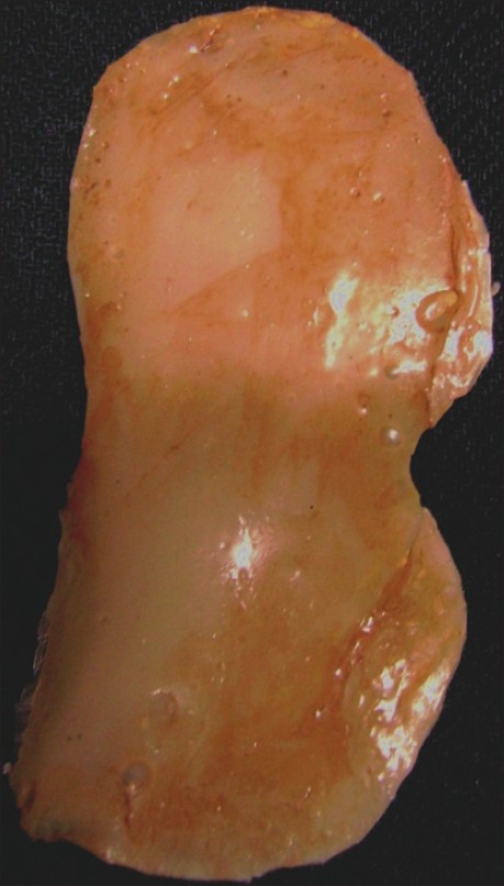 Figure 4: Defi nite silicone prosthesis