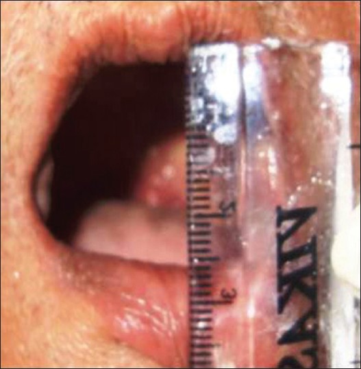 Figure 2: Restricted mouth opening (26 mm diameter)