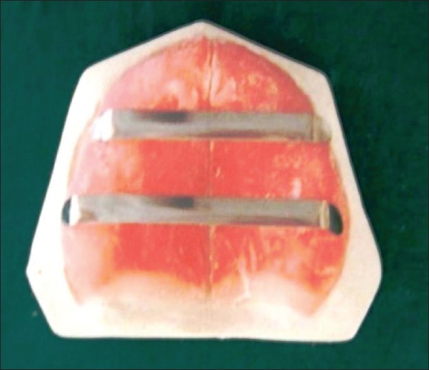Figure 5: Tongue blades for posterior stabilization of tray