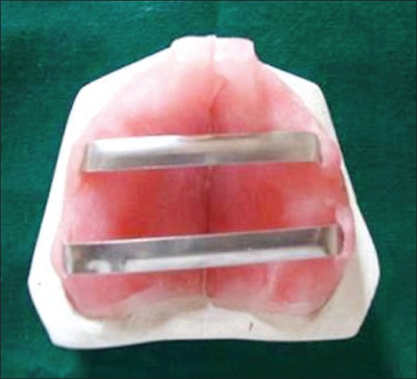 Figure 7: Sectioned maxillary custom tray