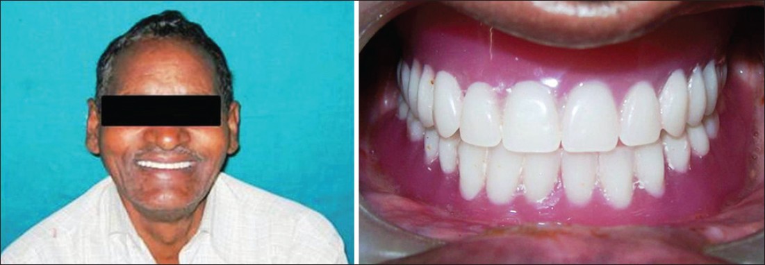 Figure 9: Finished dentures and post-operative view of the patient