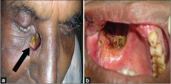Figure 2: (a) Extra-oral view, arrow indicates nasocutaneous fistula. (b) Intraoral view, indicates Aramany's Class IV maxillary defect