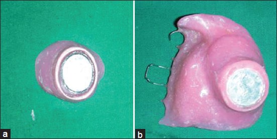 Figure 3: (a) Finished extra-oral prosthesis with magnet attachment. (b) Finished maxillary interim obturator (intaglio surface) with magnet attachment with retentive wrought stainless steel clasps