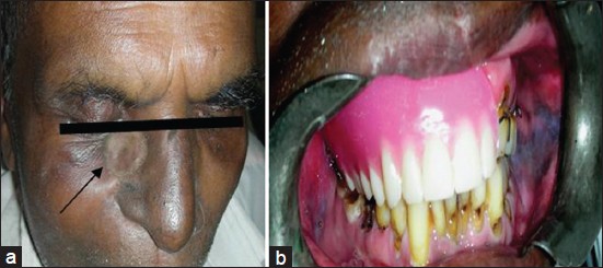 Figure 4: (a) Extra-oral view. Arrow indicates prosthesis in place. (b) Intra-oral view, prosthesis in place