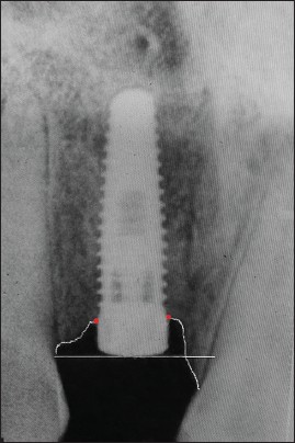 Figure 1: Intraoral periapical radiograph at 0 months