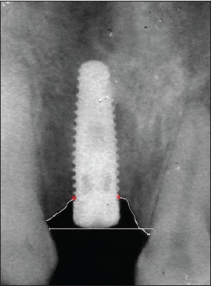 Figure 2: Intraoral periapical radiograph at 6 months
