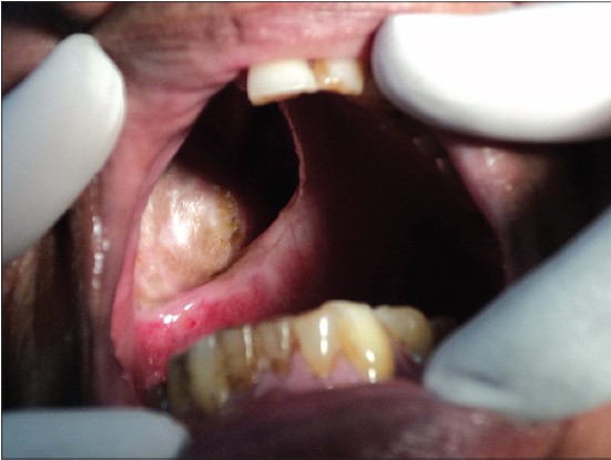 Figure 1: Intra-oral defect
