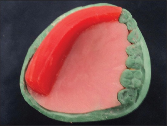Figure 3: Occlusal wax rim