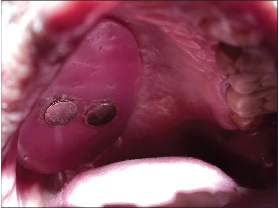 Figure 6: Bulb in patient's mouth
