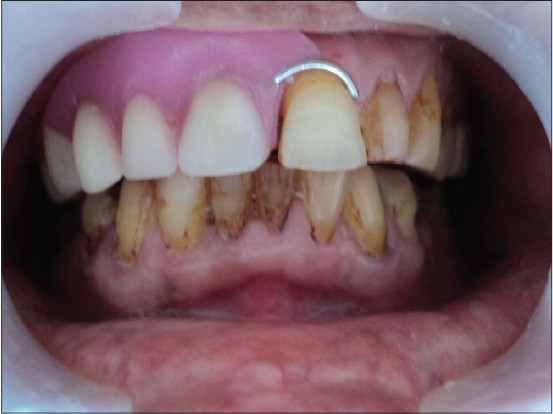 Figure 8: Prosthesis in patient's mouth