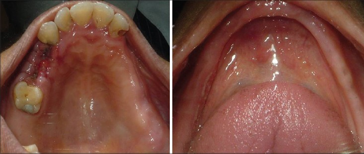 Figure 1: (a) Pre-operative view of maxillary and mandibular arch showing carious 12, 27, and unhealed sockets in the region of 24 and 25, (b) Completely edentulous mandibular arch