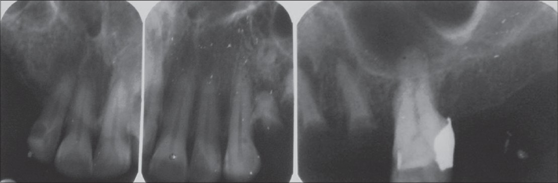Figure 2: Preoperative X-ray before extraction of teeth