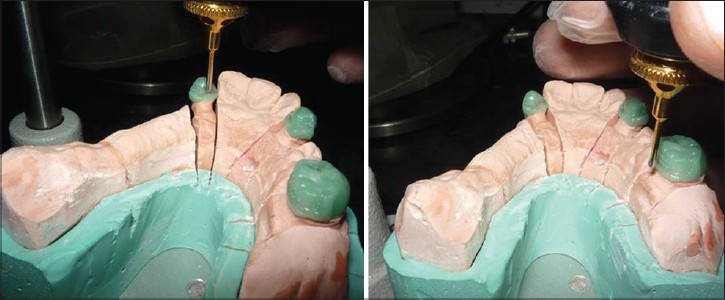 Figure 3: Wax patterns cut back and milled in wax on posterior palatal surface to create positive rests and guide plane components