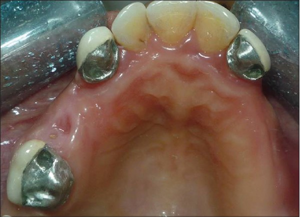 Figure 4: Milled crowns after veneering with porcelain