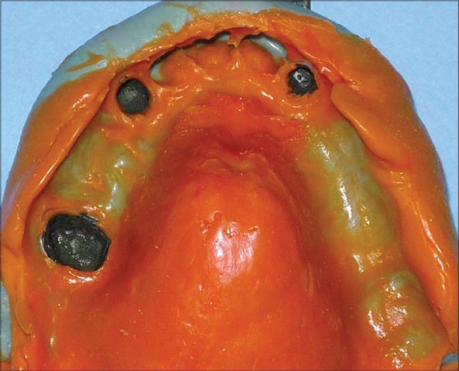 Figure 5: Pick Up Putty Wash Impression of milled crowns