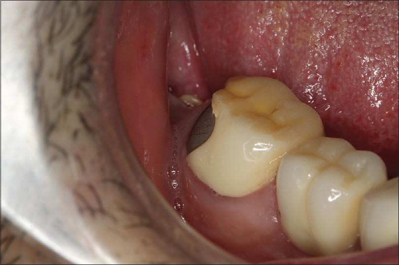 Figure 3: Clinical view of the chipped porcelain in the distal surface of the mandibular right second molar
