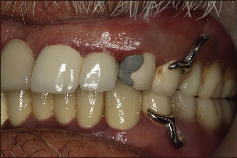 Figure 5: View of the case with a fractured porcelain in the mesio-buccal surface of the maxillary left canine