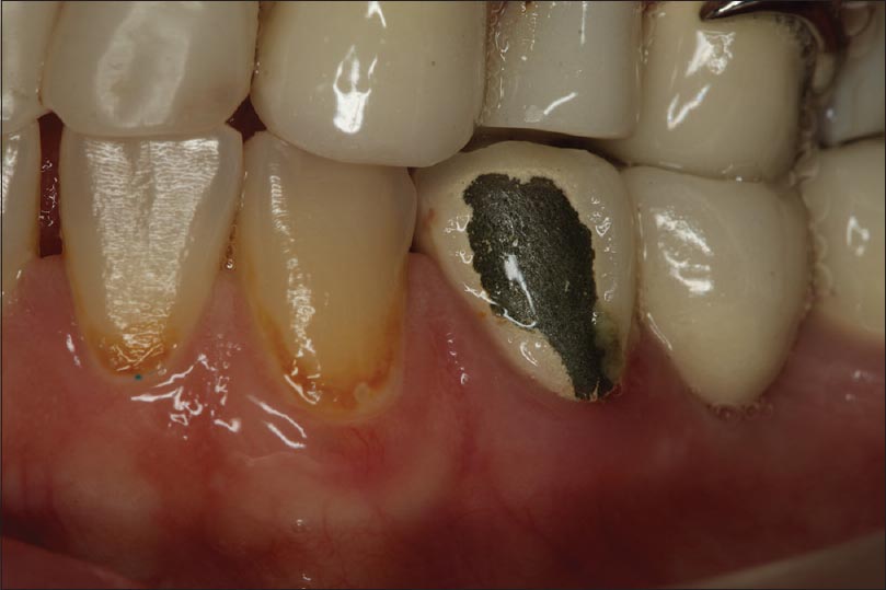 Figure 7: View of the fractured porcelain in the buccal surface of the mandibular left first premolar