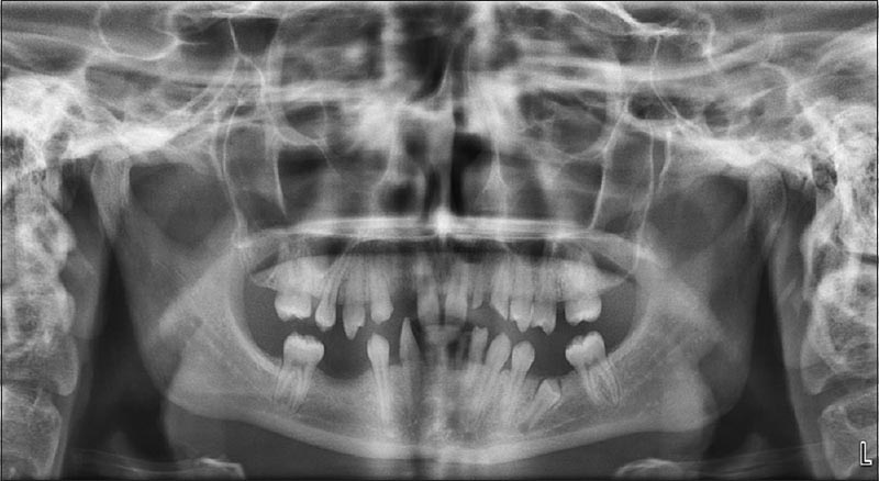 Figure 1: Preoperative panoramic radiograph of the mouth, 15 permanent teeth are absent