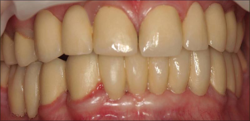 Figure 5: Maxiller and mandibular provisional restorations at the newly established occlusal vertical dimension