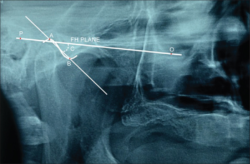Figure 1: Tracing on the right temporomandibular joint of the orthopantomogram to obtain the sagittal condylar guidance angle radiographically
