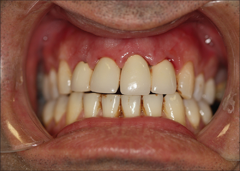 Figure 1: Intraoral view of the pretreatment condition