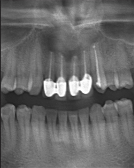 Figure 3: Radiologic view after endodontic and surgical treatment