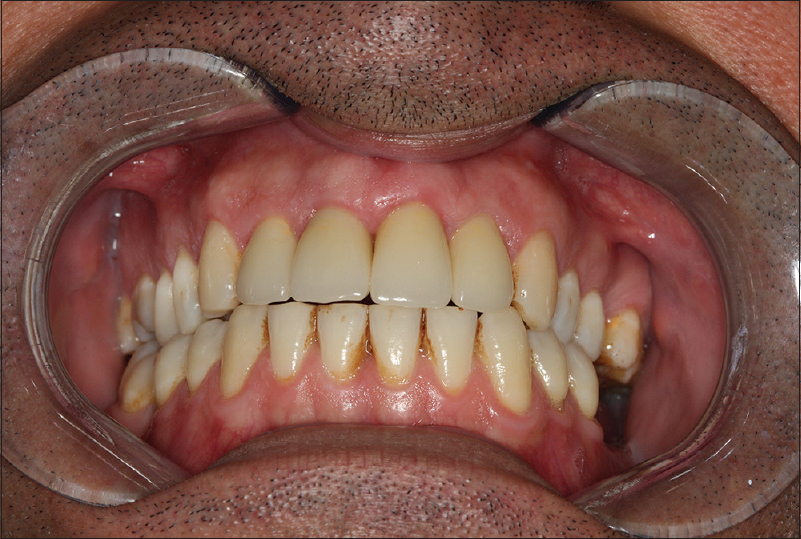 Figure 4: After prosthetic treatment (intraoral)