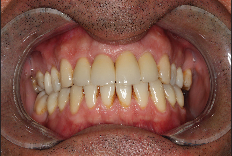 Figure 7: Two-year follow-up (intraoral)