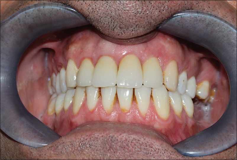 Figure 9: Five-year follow-up (intraoral)